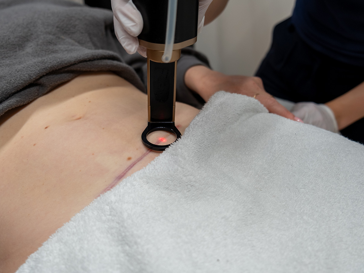 littekens verwijderen met IPL of CO2 laser